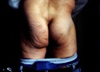 A photo of a man's naked rear end, marked up from being lashed.