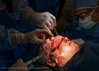 Surgeons put a face transplant on a patient.