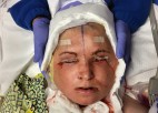 A patient lays in bed after face transplant surgery.