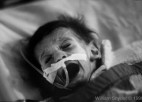 An infant suffering from AIDS screams in a bed.