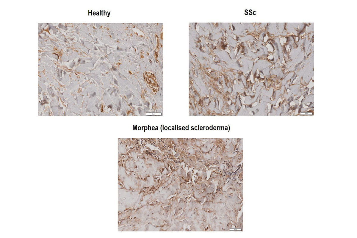 scleroderma microscopic images